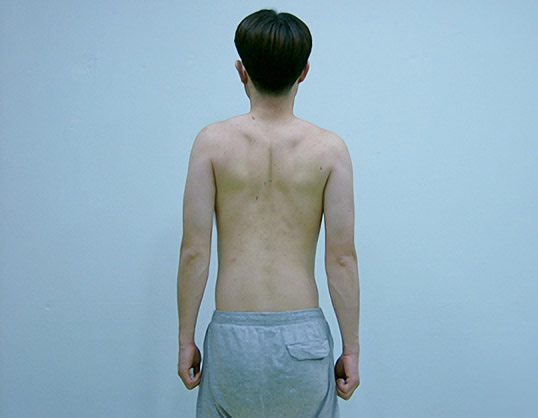 견갑골의 후인 운동